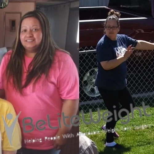 Weight Loss Surgery Before And After